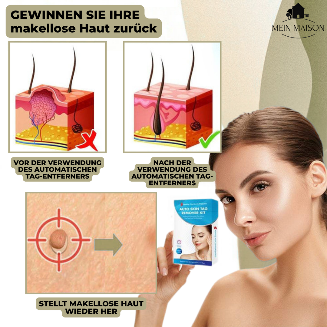 Verpakking van de effectieve wrattenverwijderaar voor moedervlekken; complete set voor thuisbehandeling.