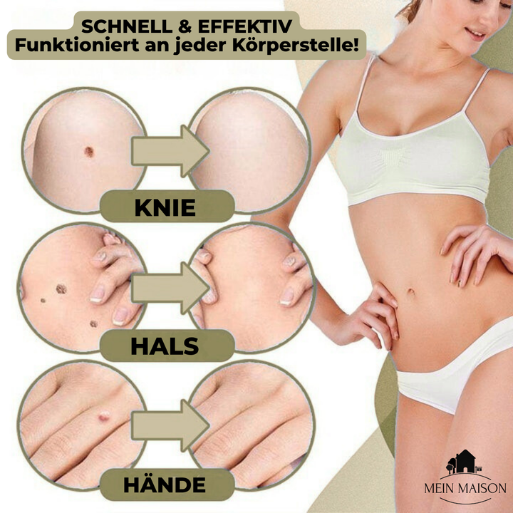 Hand toont de compacte wratten- en moedervlekken verwijderaar, ideaal voor discreet thuisgebruik.
